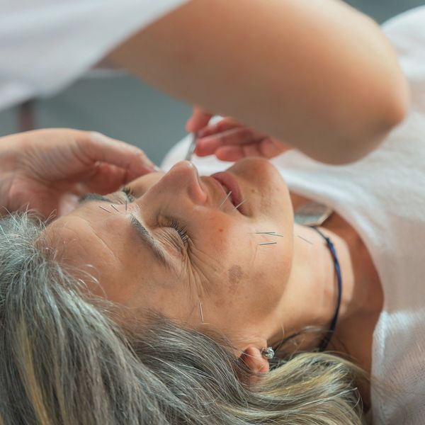 Facial acupuncture treatment